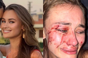 Model im Türkei-Urlaub verprügelt 