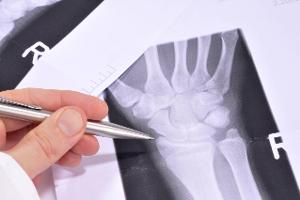Calciummangel erkennen: Das sind die Symptome FLS-TDT