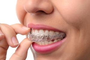Schiefen Zähnen den Kampf ansagen mit Invisalign