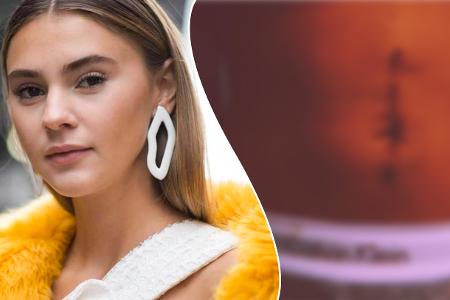 Vor Kurzem musste sich Stefanie Giesinger wegen einer Erbkrankheit operieren lassen