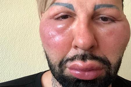 Harald Glööcklers Schwellungen gehen langsam zurück Harald Glööcklers Schwellungen gehen langsam zurück