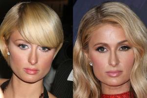 Paris Hilton hat sich nie unters Messer gelegt