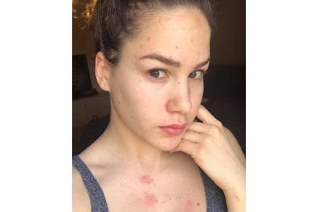 Angelina Heger steht auf Facebook zu ihren Pickelchen Angelina Heger steht auf Facebook zu ihren Pickelchen