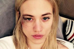 Wo hat Larissa Marolt dieses Veilchen her?