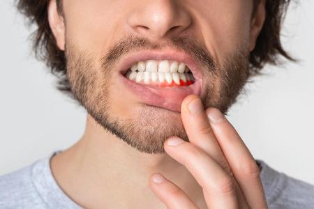 Hilfe bei Abrieb durchs Zähneknirschen