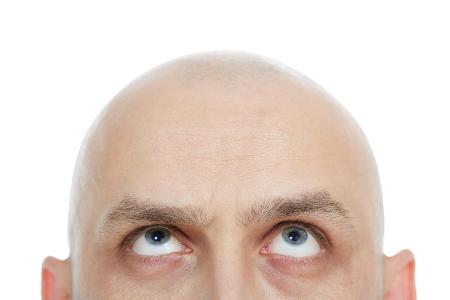 Das kostet eine Haartransplantation