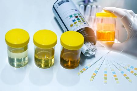 Das sagt die Urinfarbe über Ihre Gesundheit aus