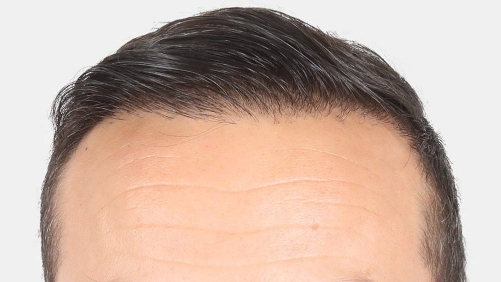 Haarlinie nach der Haartransplantation bei Cosmedica
