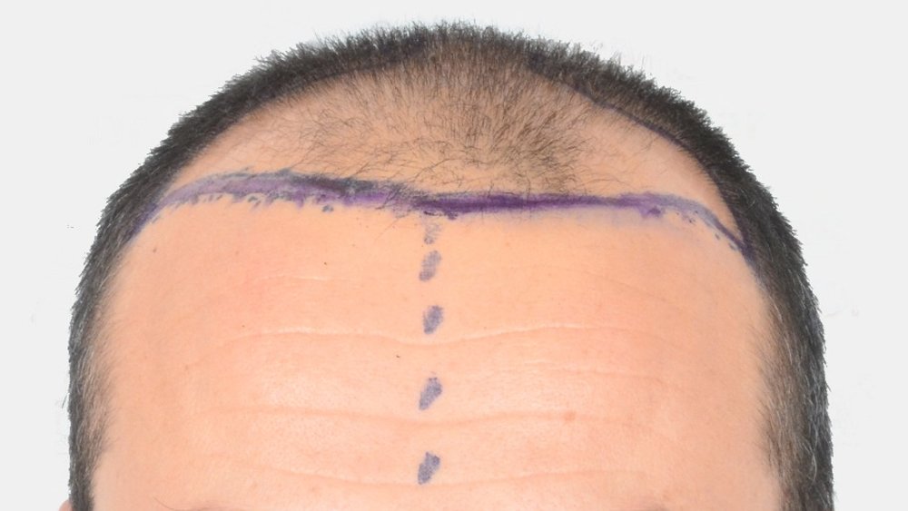 Haarlinie vor der Haartransplantation bei Cosmedica