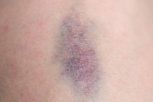 Wenn bereits leichte Stöße häufig zu blauen Flecken führen, kann das auf eine Störung der Blutgerinnung hinweisen.