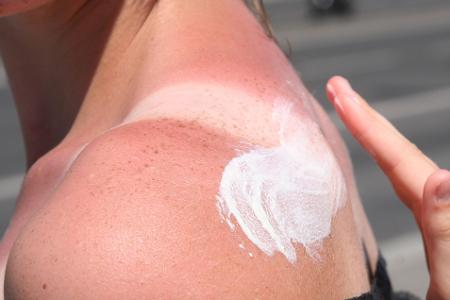 Bei Sonnenbrand ist Hautpflege gefragt: Feuchtigkeitsspendende Lotionen mit Aloe vera helfen der geschädigten Haut.